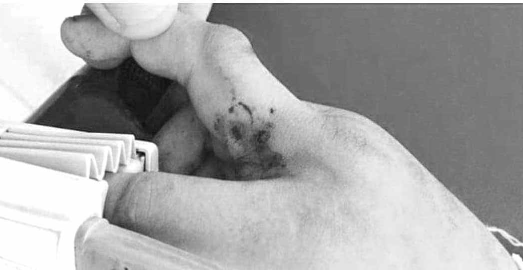 सर्पको टोकाईबाट बर्दियामा एकजना बालकको मृत्यु